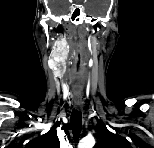 File:Carotid body tumor (Radiopaedia 83615-98727 B 67).jpg