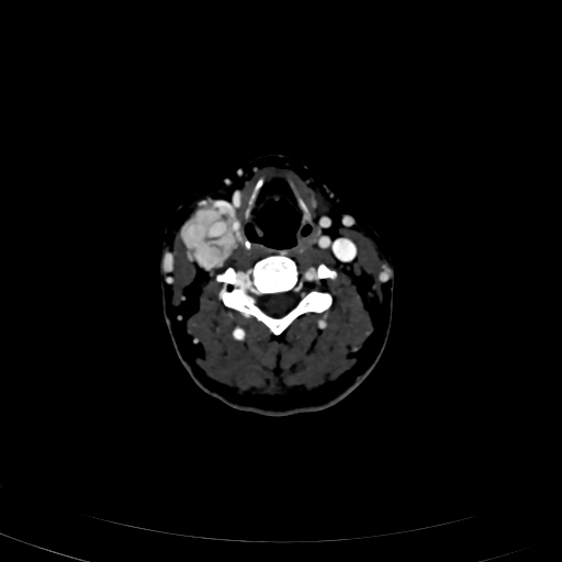 Carotid body tumor (Radiopaedia 83615-98727 D 69).jpg