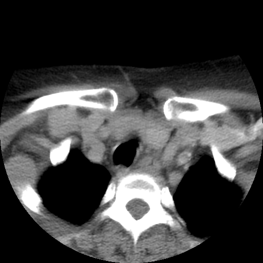 Carotid body tumor (paraganglioma) (Radiopaedia 38586-40729 A 66).jpg