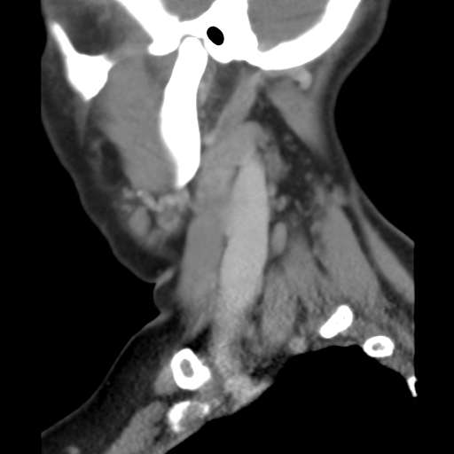 File:Carotid body tumor (paraganglioma) (Radiopaedia 38586-40729 C 23).jpg