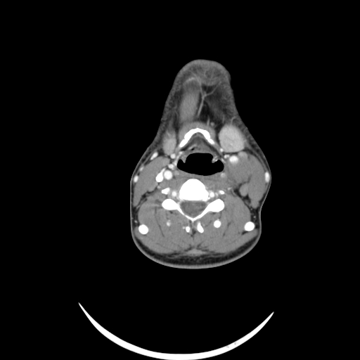 File:Carotid bulb pseudoaneurysm (Radiopaedia 57670-64616 A 38).jpg