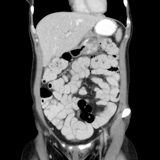 File:Castleman disease with fibrous pseudotumor in the abdomen (Radiopaedia 77296-89373 B 27).jpg