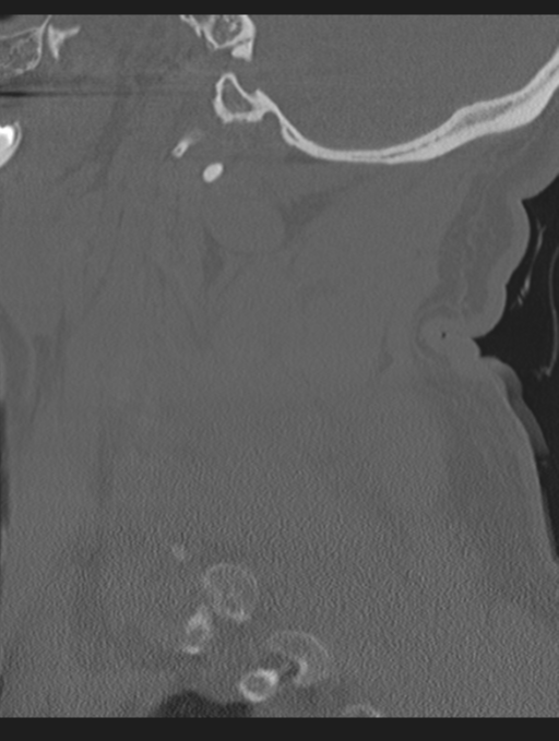 Cavernoma of cervical cord (Radiopaedia 50838-56346 Sagittal bone window 20).png