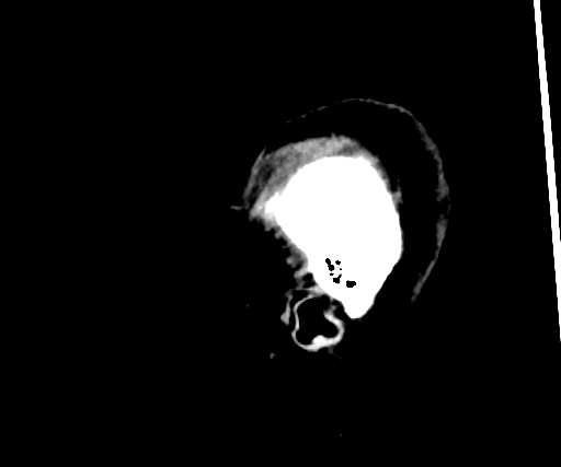 Cavernous hemangioma of the cerebellar falx (Radiopaedia 73025-83723 B 21).jpg