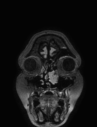 Cavernous hemangioma of the cerebellar falx (Radiopaedia 73025-83724 Coronal FLAIR 14).jpg