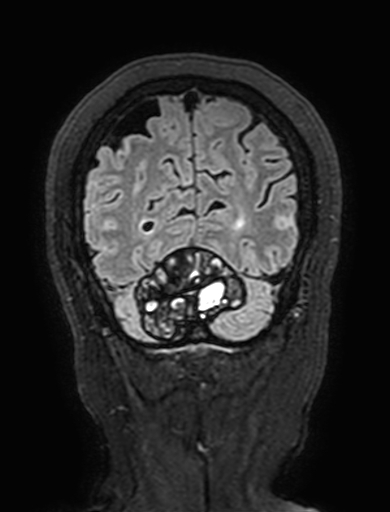 Cavernous hemangioma of the cerebellar falx (Radiopaedia 73025-83724 Coronal FLAIR 303).jpg