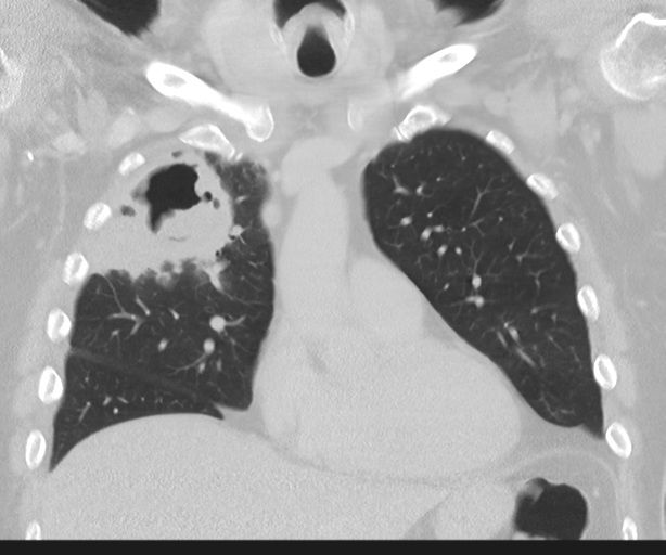 Cavitating pneumonia (Radiopaedia 45998-50329 Coronal lung window 18).png