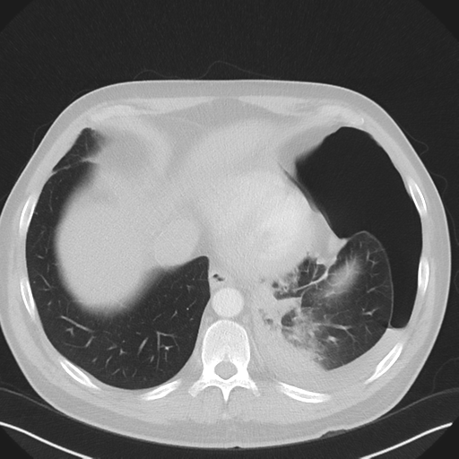 Cavitating pneumonia complicated by pneumothorax (Radiopaedia 48149-52994 Axial lung window 52).png
