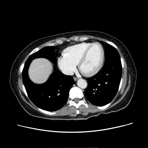 Cecal adenocarcinoma (Radiopaedia 75909-87331 A 12).jpg