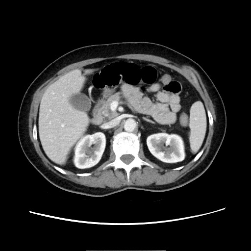 Cecal adenocarcinoma (Radiopaedia 75909-87331 A 33).jpg