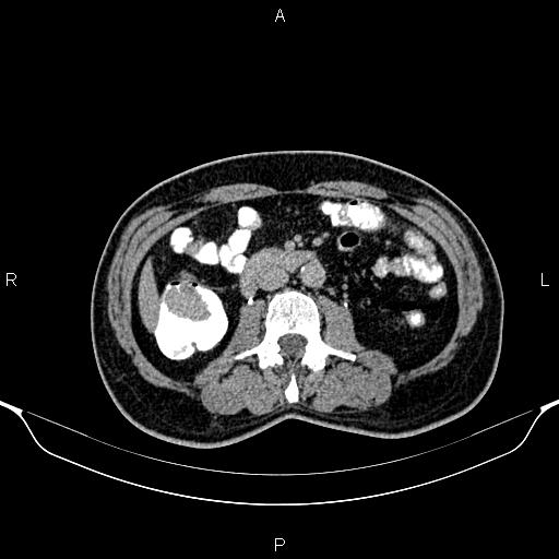 Cecal adenocarcinoma (Radiopaedia 85324-100916 Axial C+ delayed 47).jpg