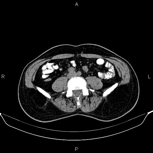 Cecal adenocarcinoma (Radiopaedia 85324-100916 Axial non-contrast 61).jpg