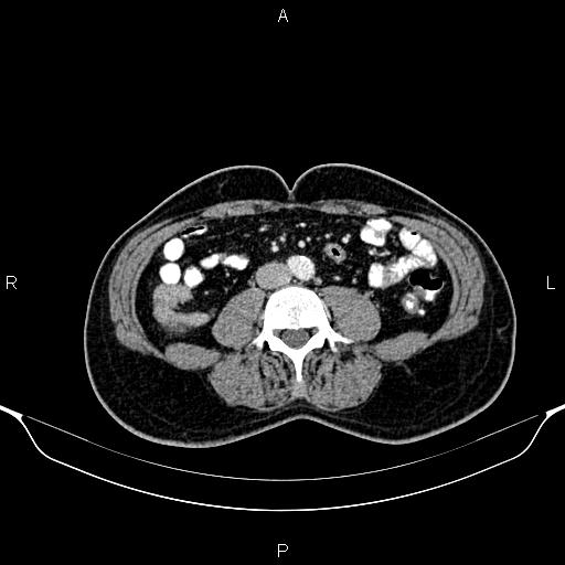 Cecal adenocarcinoma (Radiopaedia 85324-100916 B 56).jpg