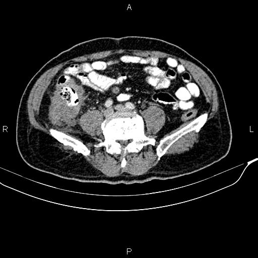 Cecal cancer with appendiceal mucocele (Radiopaedia 91080-108651 B 70).jpg