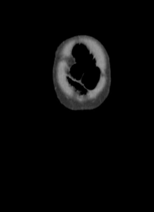 Cecal volvulus with pneumatosis coli (Radiopaedia 68572-78178 B 75).jpg