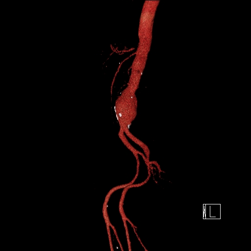 File:Celiac artery compression by the diaphragmatic crurae (Radiopaedia 31739-32666 3D CTA 15).jpg