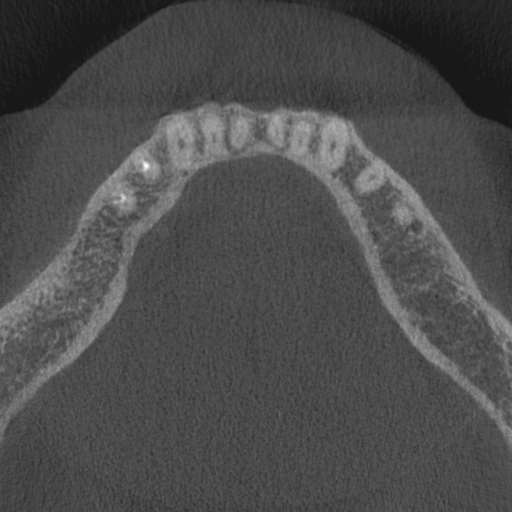 File:Cemento-osseous dysplasia (Radiopaedia 48251-53126 Axial non-contrast 30).jpg