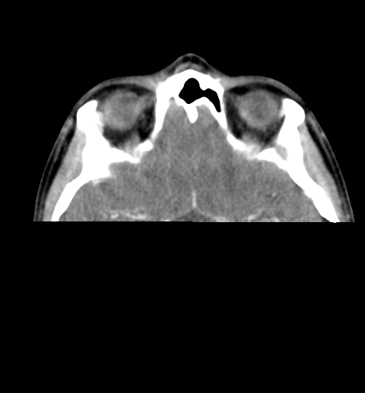 File:Cemento-ossifying fibroma (Radiopaedia 46243-50643 Axial C+ delayed 12).png