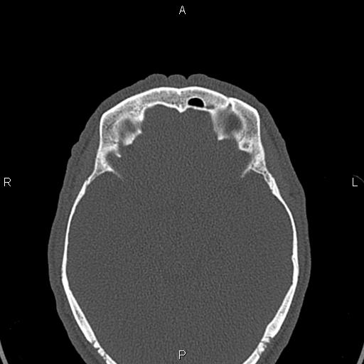 Central giant cell granuloma (Radiopaedia 83346-97761 Axial bone window 71).jpg