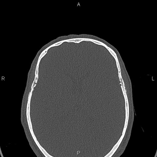 File:Central giant cell granuloma (Radiopaedia 83346-97761 Axial bone window 86).jpg