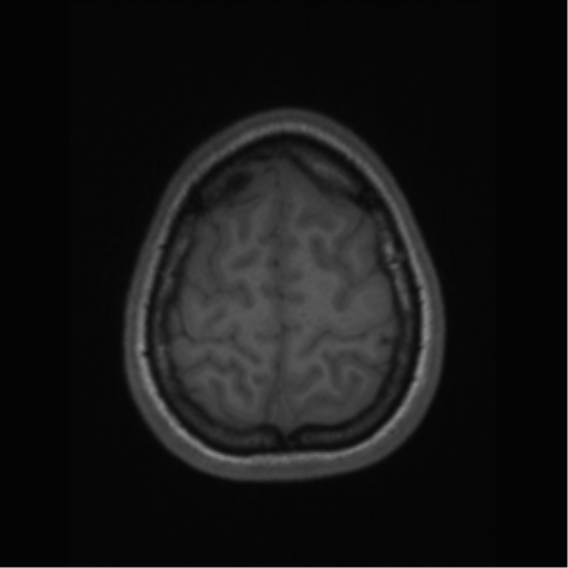 File:Central neurocytoma (Radiopaedia 37664-39557 Axial T1 64).png