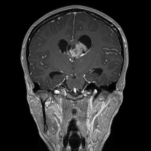 Central neurocytoma (Radiopaedia 37664-39557 Coronal T1 C+ 44).png