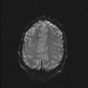Central neurocytoma (Radiopaedia 56690-63469 Axial DWI 17).jpg
