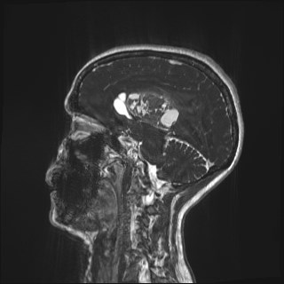 Central neurocytoma (Radiopaedia 84497-99872 Sagittal CISS 29).jpg