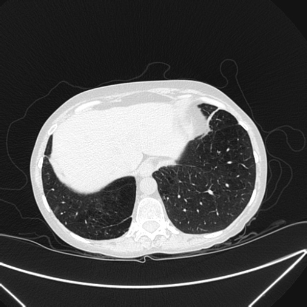 Centrilobular pulmonary emphysema (Radiopaedia 24495-24789 Axial lung window 79).jpg