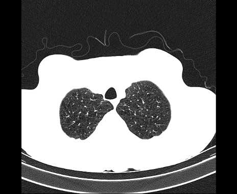 Centrilobular pulmonary emphysema (Radiopaedia 62468-70718 Axial lung window 10).jpg