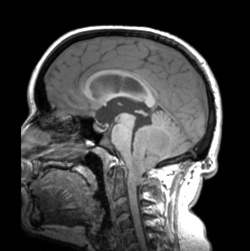 File:Cerebellar ependymoma complicated by post-operative subdural hematoma (Radiopaedia 83322-97736 Axial T1 39).png