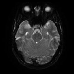 Cerebellar hemangioblastoma (Radiopaedia 29570-30077 Axial DWI 36).jpg
