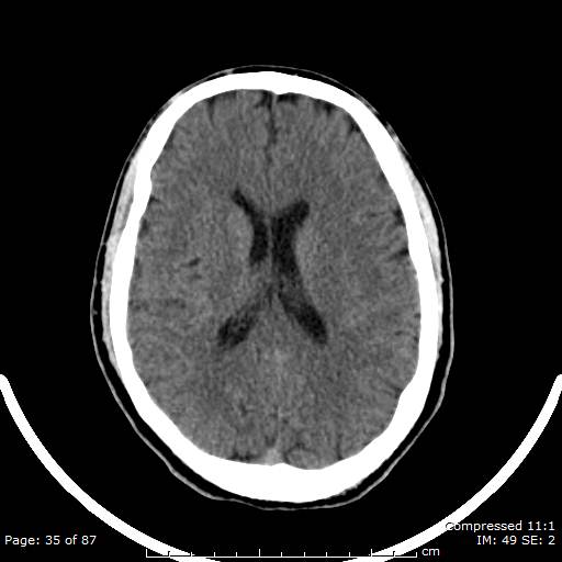 Cerebellar hemangioblastoma (Radiopaedia 52360-58258 Axial non-contrast 35).jpg
