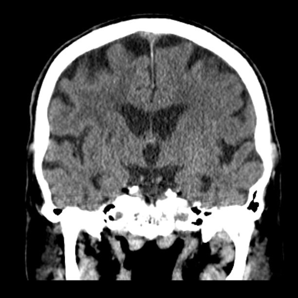Cerebellar hemorrhage (Radiopaedia 27193-27359 Coronal non-contrast 29).jpg