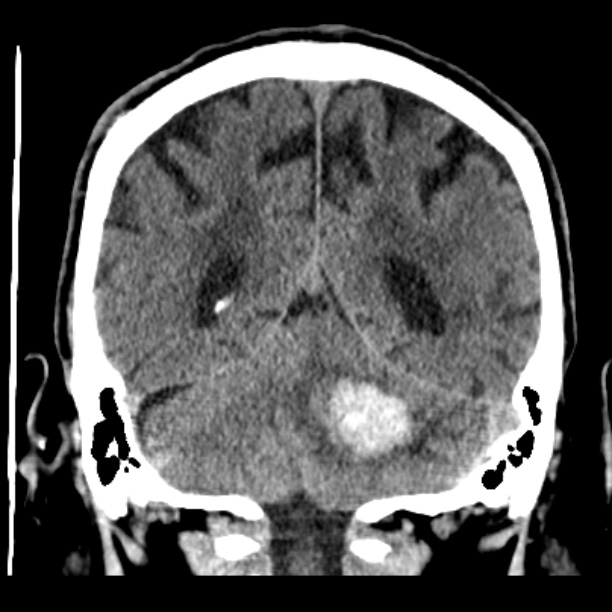 Cerebellar hemorrhage (Radiopaedia 27193-27359 Coronal non-contrast 41).jpg