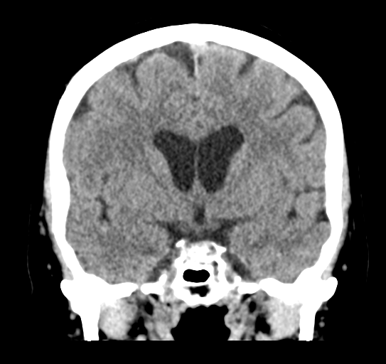 Cerebellar metastasis (Radiopaedia 54578-60812 Coronal non-contrast 25).png