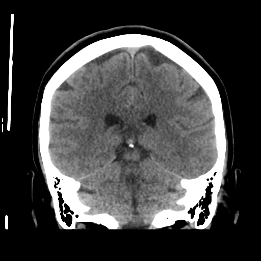 Cerebellar metastasis (cystic appearance) (Radiopaedia 41395-44258 Coronal non-contrast 40).png