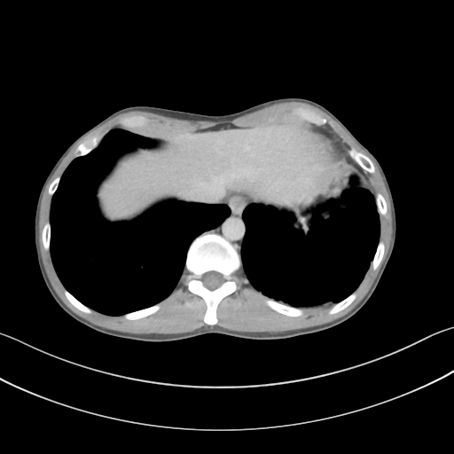 File:Cerebellar metastasis - adenocarcinoma lung (Radiopaedia 63184-71717 Axial C+ delayed 58).png