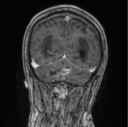 Cerebellar metastasis from lung adenocarcinoma (Radiopaedia 86690-102829 Coronal T1 C+ 24).png