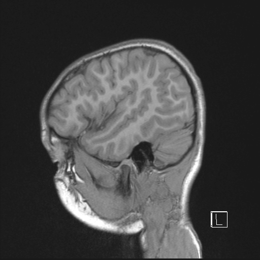 File:Cerebellar stroke (Radiopaedia 32202-33150 Sagittal T1 C+ 10).png