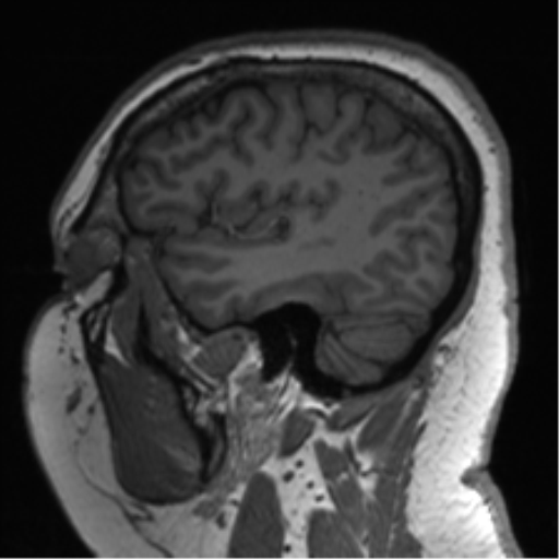 Cerebellopontine angle meningioma (Radiopaedia 48434-53348 Sagittal T1 70).png