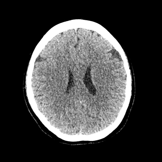 Cerebellopontine angle meningioma (Radiopaedia 53561-59592 Axial non-contrast 43).jpg