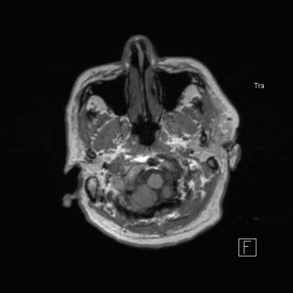 Cerebral abscess (Radiopaedia 26111-26247 Axial T1 14).jpg