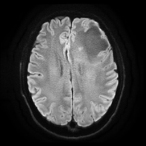 Cerebral abscess (Radiopaedia 57774-64740 Axial DWI 18).png
