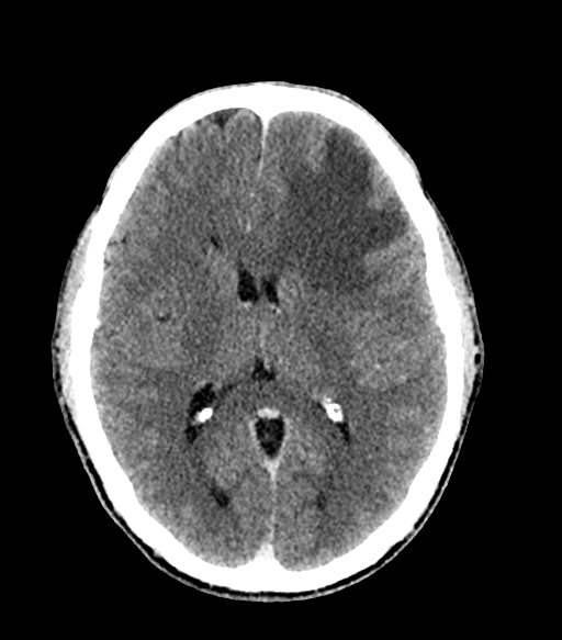 Cerebral abscess (Radiopaedia 57774-64741 Axial C+ delayed 38).png