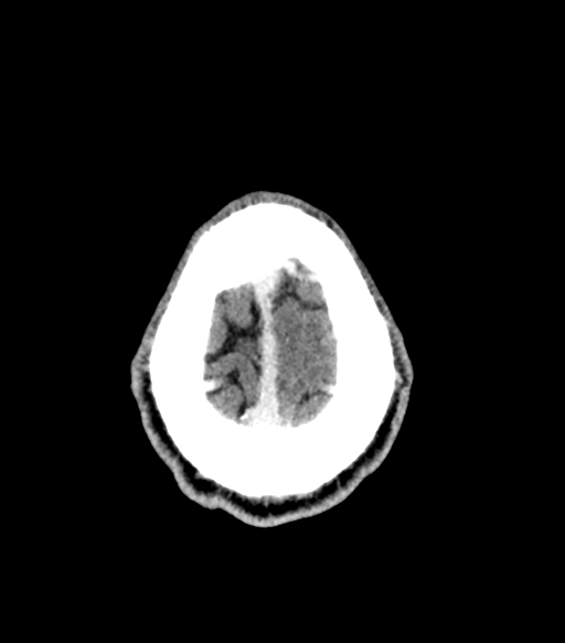 Cerebral abscess (Radiopaedia 57774-64741 Axial C+ delayed 57).png