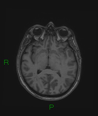 Cerebral abscess and subdural empyema (Radiopaedia 84436-99779 Axial T1 45).jpg