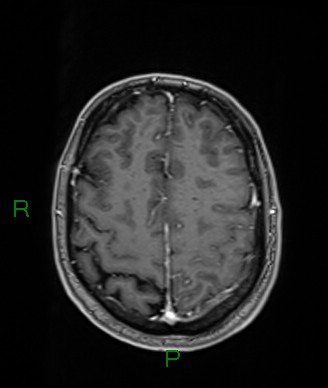 Cerebral abscess and subdural empyema (Radiopaedia 84436-99779 Axial T1 C+ 24).jpg