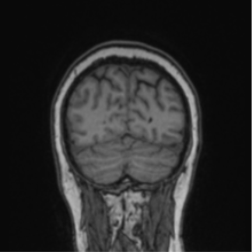 Cerebral abscess from pulmonary arteriovenous malformation (Radiopaedia 86275-102291 Coronal T1 20).png
