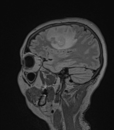 Cerebral abscess from pulmonary arteriovenous malformation (Radiopaedia 86275-102291 Sagittal FLAIR 54).png
